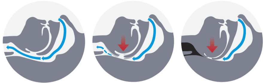 avanço mandibular narval cc avanço mandibular narval cc